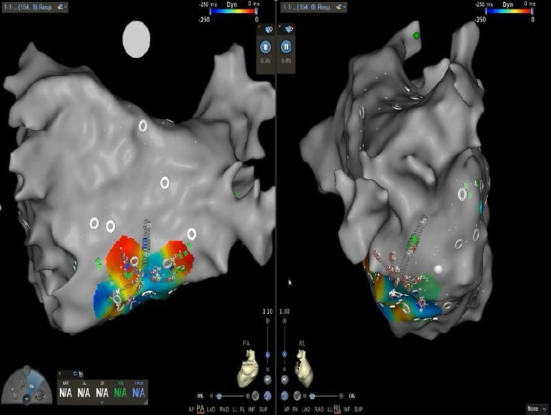 Персонализированный подход в кардиологии: в НМИЦ эндокринологии имени академика Ивана Дедова внедрили инновационный алгоритм лечения аритмии у пациентов с диабетом